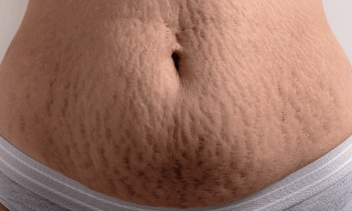 DERMA 4. ESTRÍAS Y MARCAS