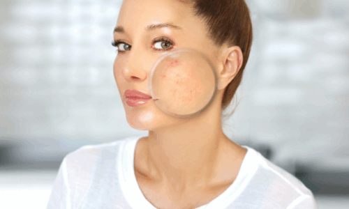 DERMA 6. ACNÉ